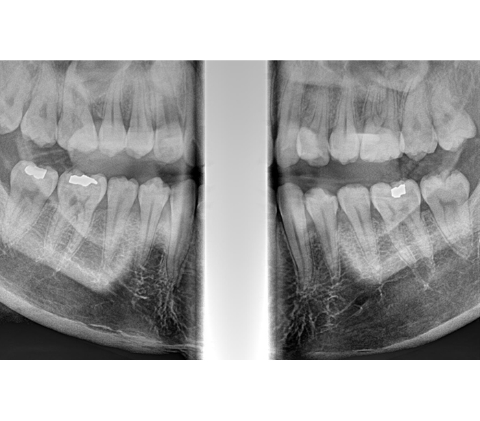 Genoray - Papaya 3D Plus (OPG) X-Ray Imaging System